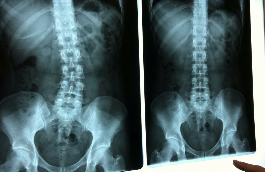 Zwei Röntgenbilder der Lendenwirbelsäule